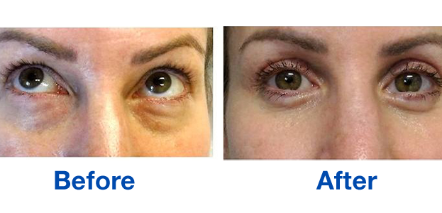 Lower eyelid blepharoplasties