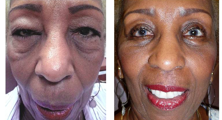 before and after image of eyelid surgery