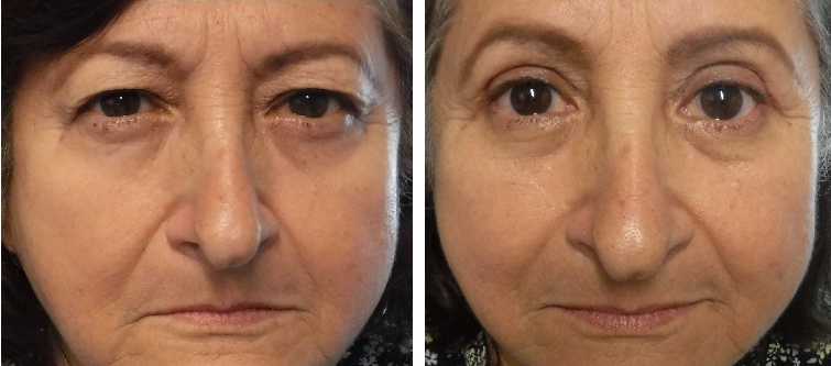 before and after photo four lid blepharoplasty and ptosis