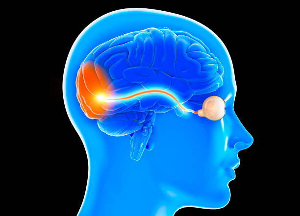 Optic nerve, section of the brain seen from the side. Nerve injury. Poor eyesight. Optic neuritis. Inflammation, partial or total loss of vision, 3d rendering